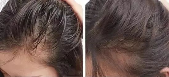 亚麻籽究竟有多神奇?用它,头发蓬松不出油,关键是拯救秃头!(图9)