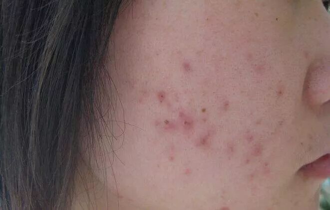 螨虫一除,再回婴儿肌,痘痘不是顽疾!(图14)