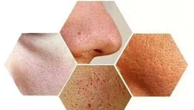 螨虫一除,再回婴儿肌,痘痘不是顽疾!(图8)