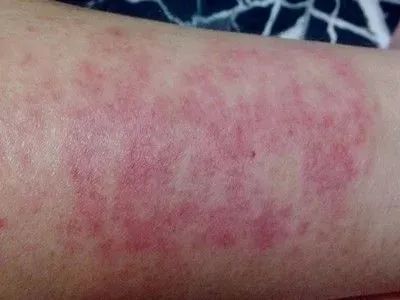 澳洲茶树精油沐浴露除螨祛痘,守候肌肤健康(图9) 图片