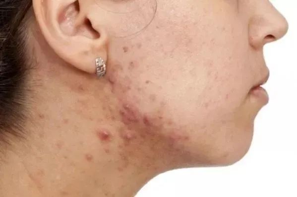 澳洲茶树精油沐浴露除螨祛痘,守候肌肤健康(图7) 图片