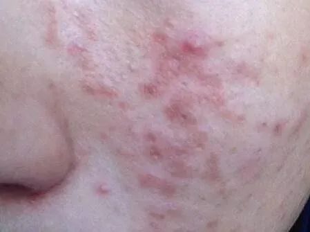 澳洲茶树精油沐浴露除螨祛痘,守候肌肤健康(图8) 图片